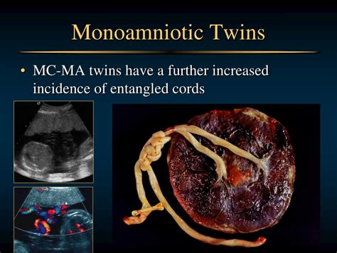 PPT - Monochorionic Twins and Twin Transfusion Syndrome PowerPoint ...