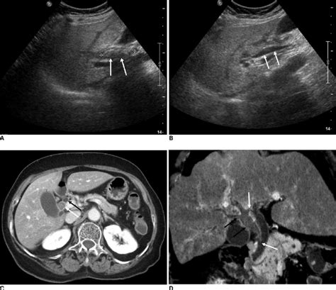 Year Old Woman With Duplication Of Extrahepatic Bile Duct A