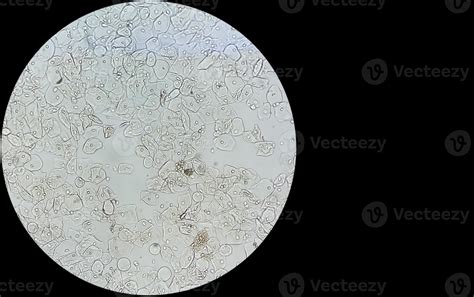 Epithelial Cell In Urine