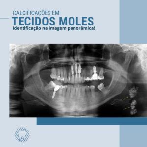 Calcifica Es Em Tecidos Moles Indentifica O Na Imagem Panor Mica