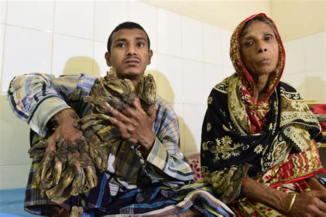 Bangladesh Tree Man With Warts Resembling Tree Growths Finally Has Surgery On Hands And Feet