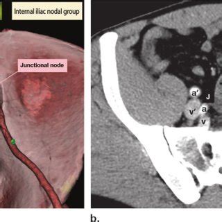 External iliac lymph node group. Illustration (a) and axial... | Download Scientific Diagram