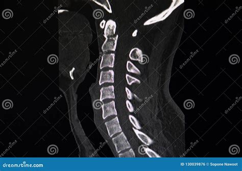 Fracture C Cervical Vertebrae Stock Photo Image Of Information