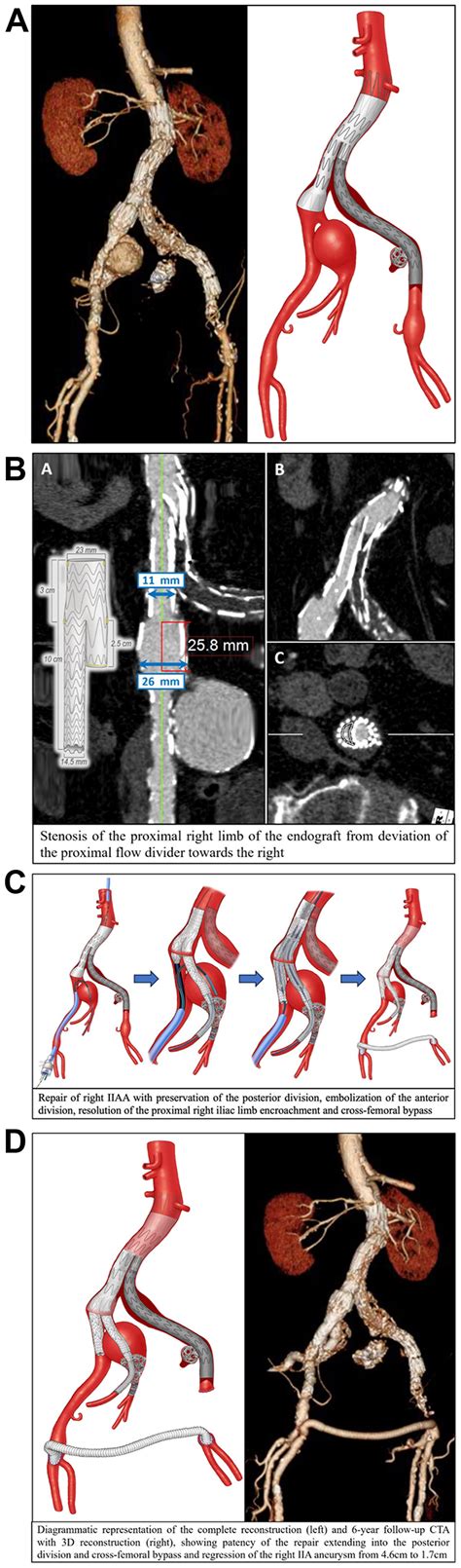 Internal Iliac Artery Aneurysm Repair Using An Iliac Branch