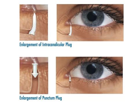 Dry Eye Treatment At Handel Vision Clinic