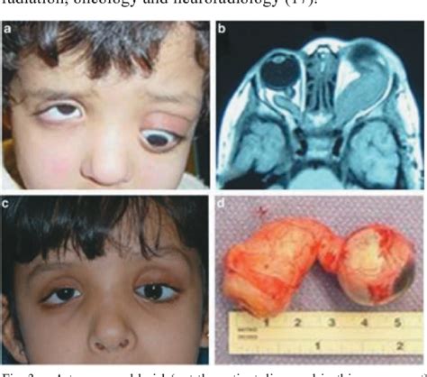 Figure 1 from Lisch and the Importance of His Nodules. | Semantic Scholar