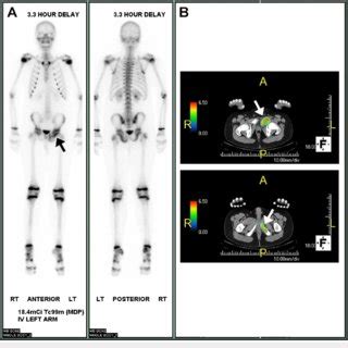 Nuclear Medicine Imaging Technetium 99m Methyl Diphosphonate Tc