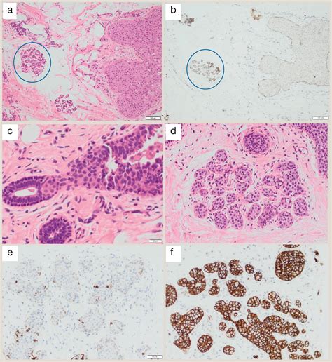 Atypical Breast Lesions A Challenging Pathological Diagnosis And An Uncertain Malignant