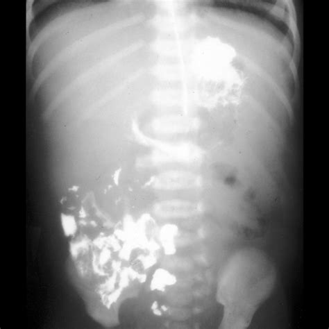 Ligament Of Treitz Malrotation