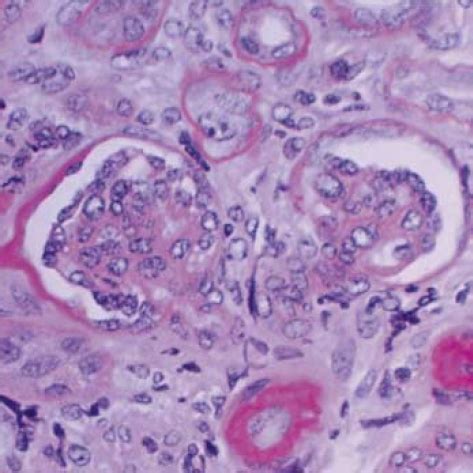 Renal Biopsy Showing Glomeruli With Diffuse Mesangial Sclerosis PAS