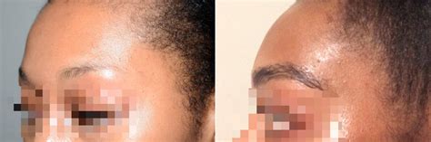 Eyebrow Transplantation Photos Eyebrow Transplant Miami