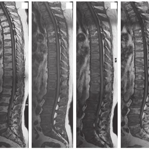 Signal variations observed on MRI STIR-weighted images (A) prior to ...