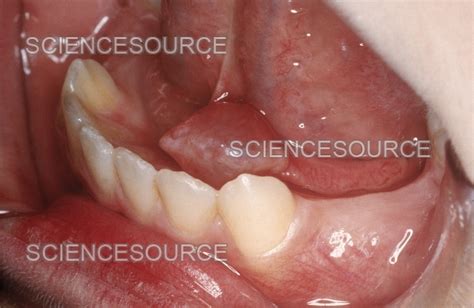 Blocked Salivary Gland Under Tongue