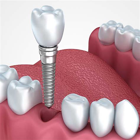 Fabricante de Prótesis Sobre Implantes CDCLAM