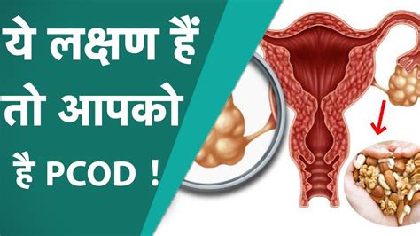 Pcod Pcos की समस्या से कैसे पाएं निजात इन लक्षणों को ना करें नजरअंदाज