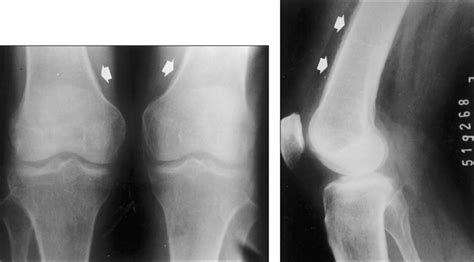 Radiografias Dos Joelhos Em Ntero Posterior A E Perfil Do Joelho