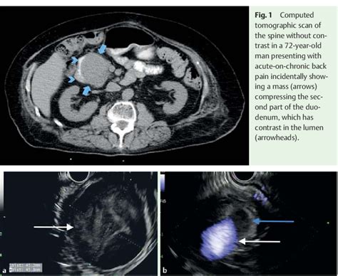 A Endoscopic Ultrasound Showing A Heterogeneous Mass Arrow Posterior Download Scientific