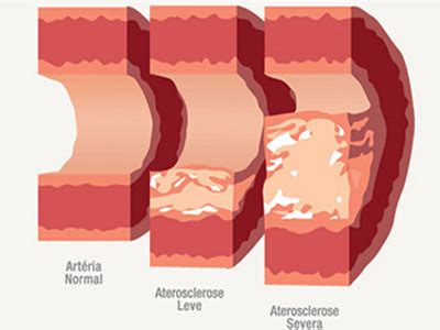Aterosclerose Sintomas Tratamento E Preven O Seu Guia De Sa De
