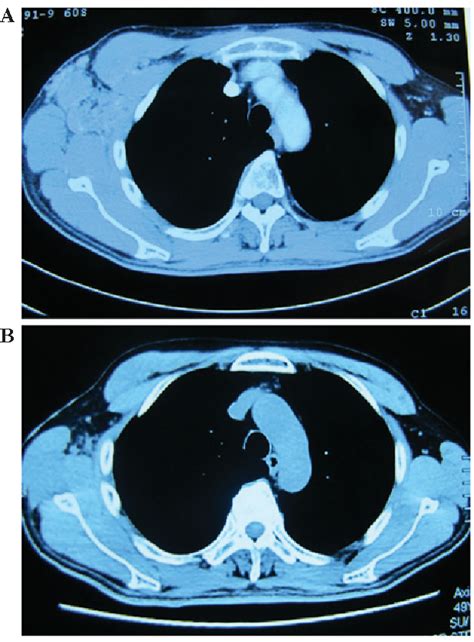 Figure 2 From Male Breast Cancer Arising In Ectopic Axillary Breast