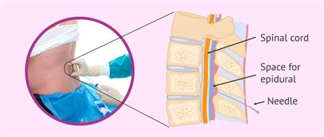 Epidural Anesthesia During Labor Benefits And Side Effects