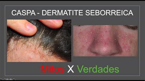 Caspa Dermatite Seborreica Mitos E Verdades Luiz Gameiro