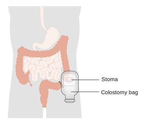 Colostomy Diagram