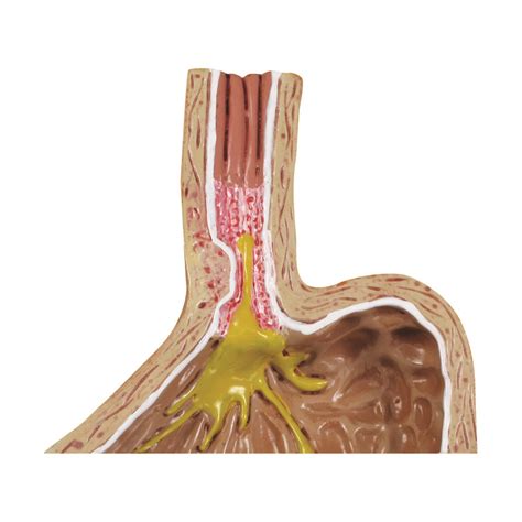 Gpi Modell Einer Gastro Sophagealen Refluxkrankheit