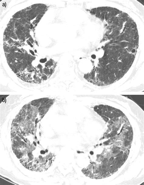 Acute Exacerbation Of Idiopathic Pulmonary Fibrosis Frequency And Clinical Features European