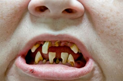 Rotten Teeth Causes Treatment And Pictures