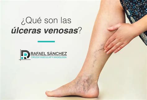 Qué son las úlceras venosas Doctor Rafael Sánchez