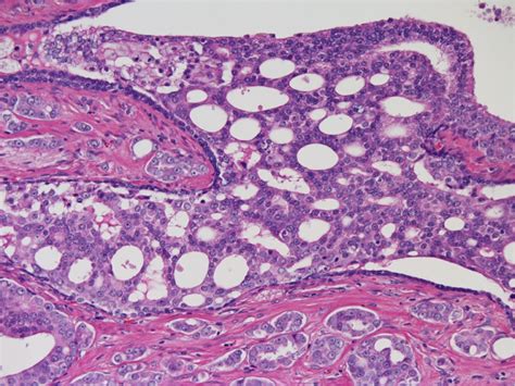 Prostate Cancer Pathology