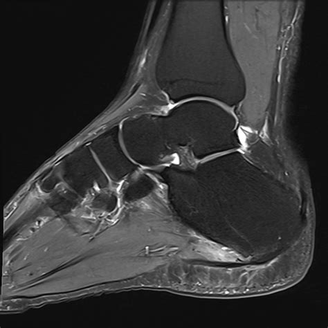 Painful Os Peroneum Syndrome Pops Image