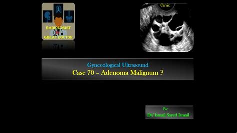 Ultrasound Case 70 Adenoma Malignum Of The Cervix Youtube