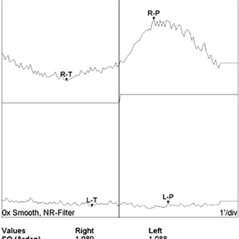 Electro-oculogram of both eyes. The EOG light rise of the left eye is ...