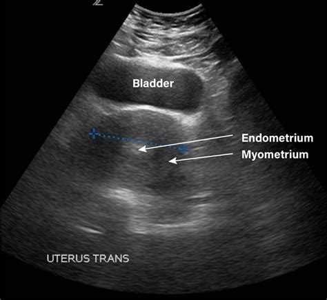 Gynecology Pelvic Ultrasound Made Easy Step By Step Guide Artofit