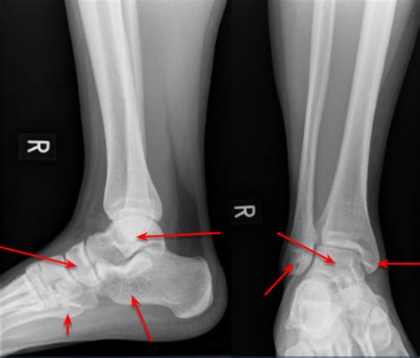 Foot Bony Anatomy Xray Diagram Quizlet