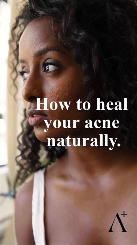 The Simple 7 Step Program To Clear Acne Naturally Artofit