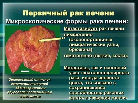 Заболевания печени - презентация онлайн
