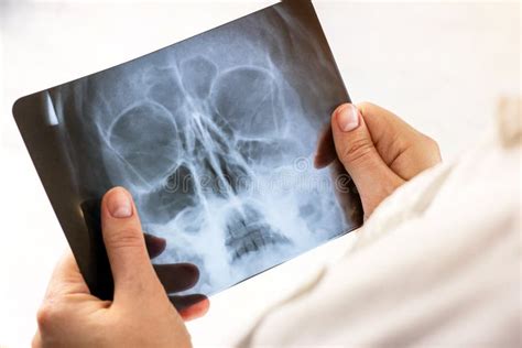Magnetic Resonance Scan Of A Human Brain With Skull In Doctor Hands