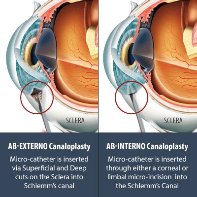 Ab Interno Versus Ab Externo Canaloplasty New Glaucoma Treatments