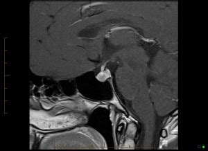 Brain with contrast showing normal enhancement of the pituitary gland - MRI at Melbourne ...