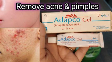 Remove Acne And Pimples Adapco Gel For Acne Chehre Se Dane Khatam