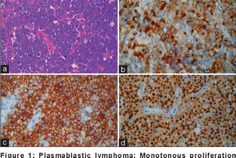 Table 1 From Extranodal Non Hodgkins Lymphoma A Case Series Semantic Scholar