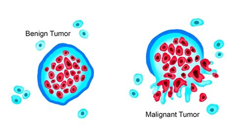 Benign Vs Malignant Cells