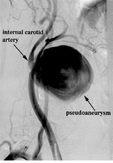 Angiography Shows The Pseudoaneurysm Of The Right Common Carotid Artery Download Scientific