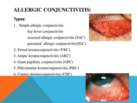 Allergic Conjunctivitis