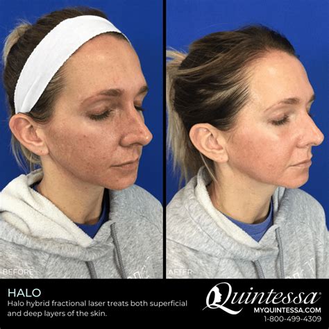 Halo Laser Treatment Milwaukee And Madison Quintessa