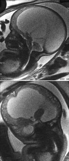 Sagittal Upper And Coronal Lower Single Shot Fast Spin Echo T