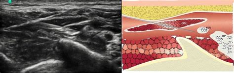 Suprascapular Nerve Block Ultrasound