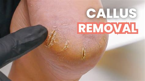 Huge Heel Cracks Callus Removal Youtube